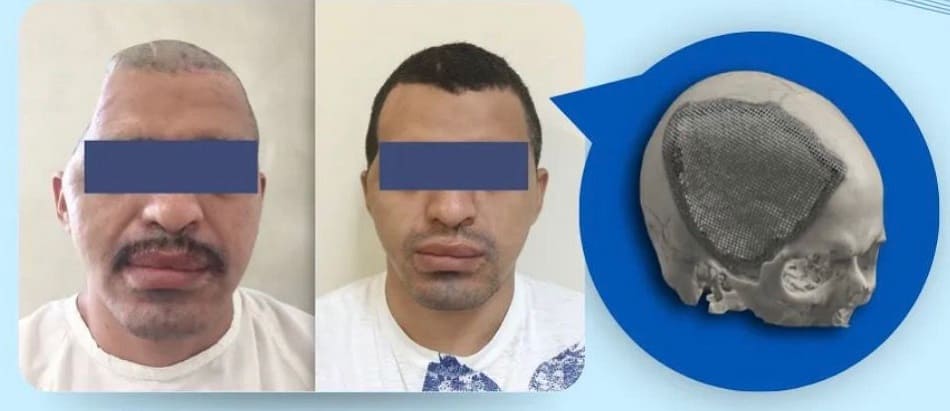 Implantes médicos 3D a la medida en Ecuador